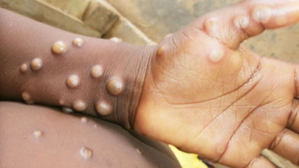‘No need to panic’, says K’taka govt on Monkeypox case