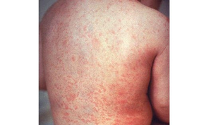 Measles outbreak kills five children in Uganda