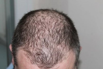 Study shows low doses of antibiotics can help treat a rare hair loss problem