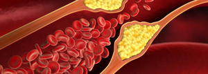 Reduce your bad cholesterol levels to keep Alzheimer’s, dementia at bay