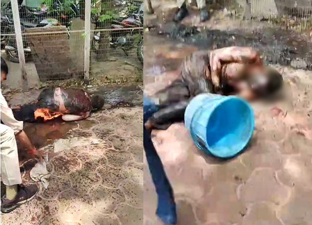 MP: Man set himself on fire in Bhopal, admitted to hospital with over 40 pc burn injuries