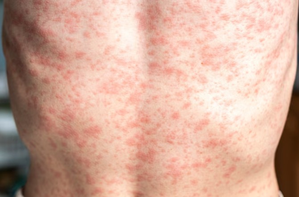 Over 900 measles cases reported in US so far in 2025: CDC