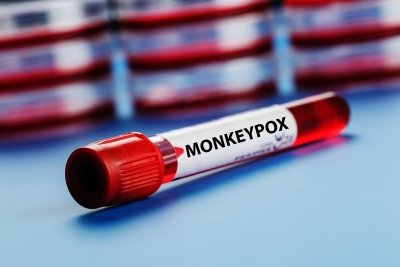 Spain confirms 1st human transmission of mpox clade 1b outside Africa