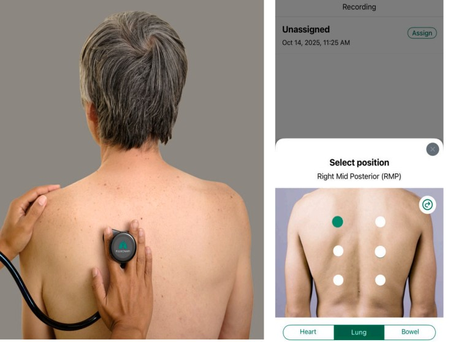 AI-powered digital stethoscopes show promise in bridging screening gaps