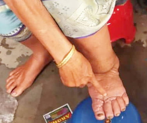 Mass drug programme against filariasis to begin in Gujarat from Feb 10, covering 5.48 lakh