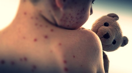 Measles outbreak intensifies in Bangladesh amid rising infections