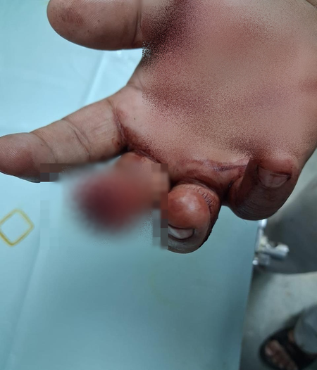 Bloody brawl at samosa-cutlet shop in Mumbai: Customer bites off shopkeeper’s finger, accused arrested