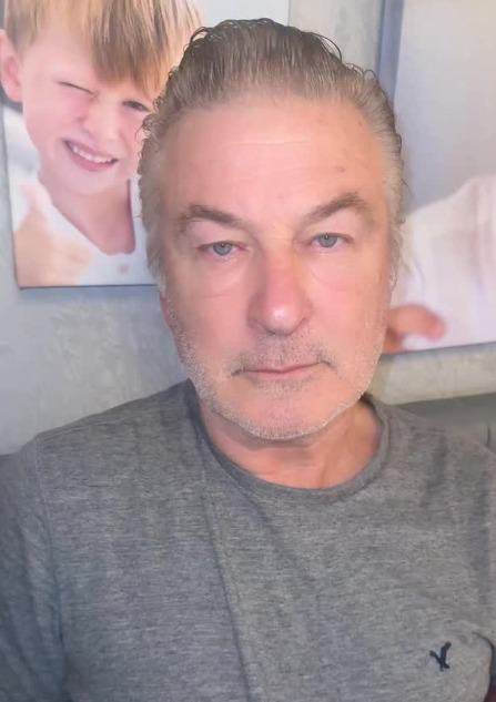 Alec Baldwin’s son, Leo split his forehead open during vacation