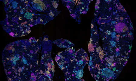 Australian study identifies early blood marker for lung cancer risk