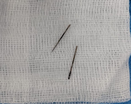Gujarat: 12-year-old swallows metal pin; AIIMS Rajkot doctors remove it without surgery
